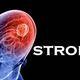 Illustration for article titled Obat Pasca Stroke Iskemik